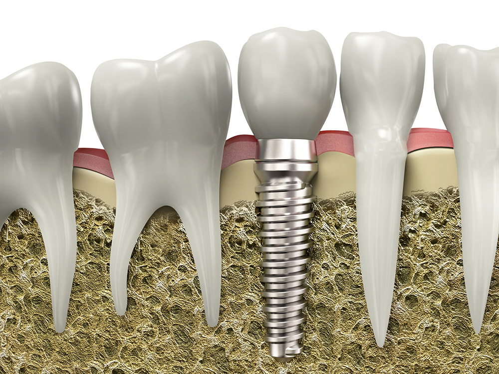 dental implant in sw calgary