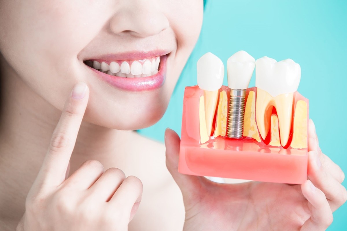 3 Types of Dental Implants : Which One Is Best for You?
