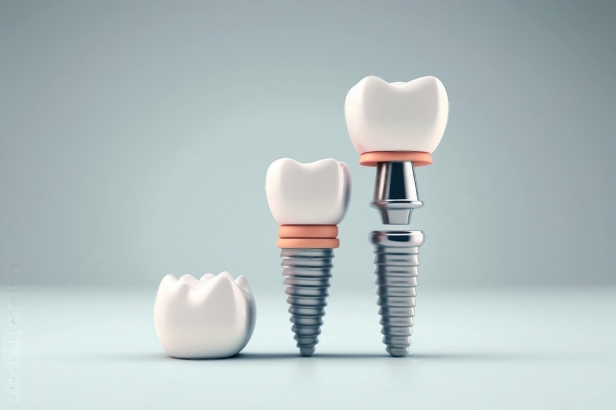 10 Interesting Facts About Dental Implants