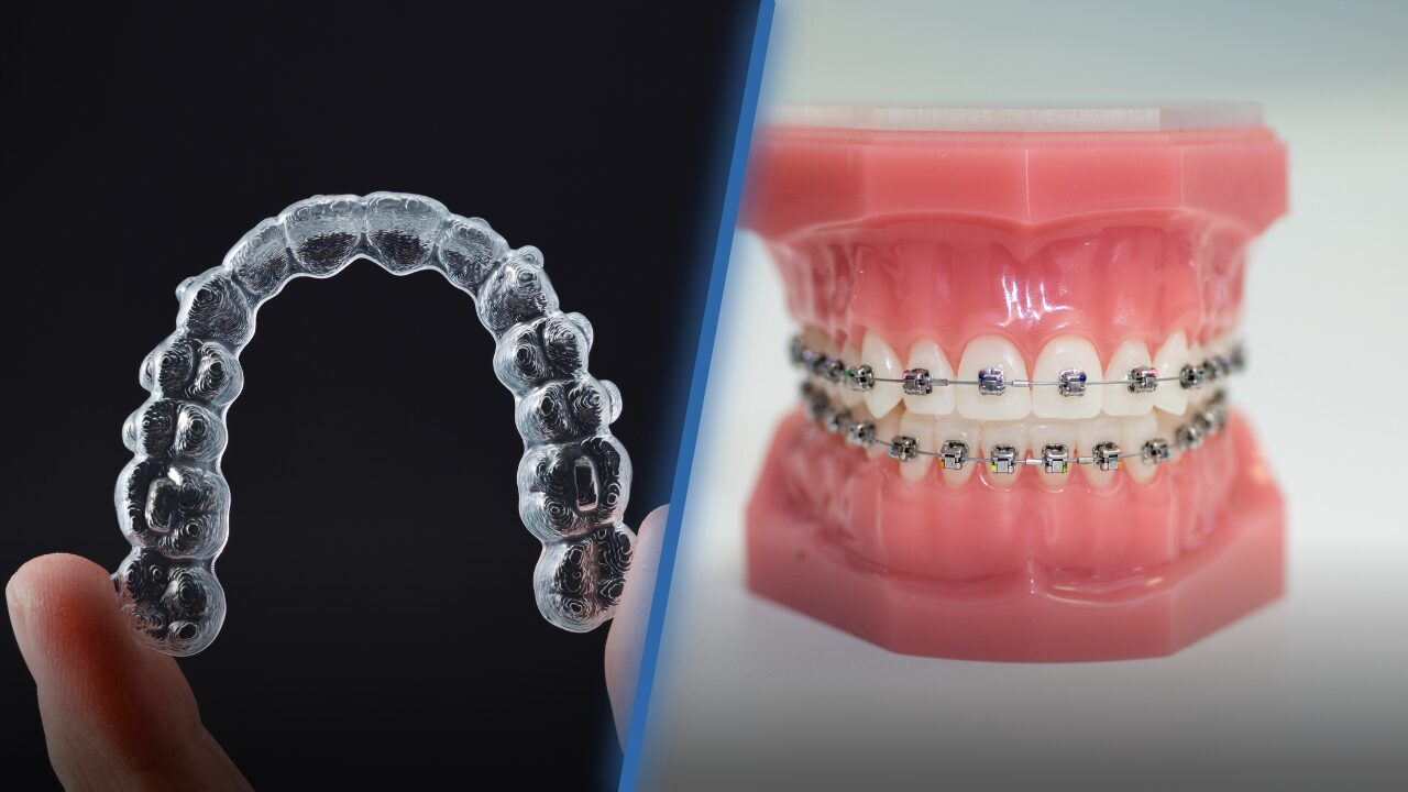 Choosing Between Damon Braces or Invisalign Aligners