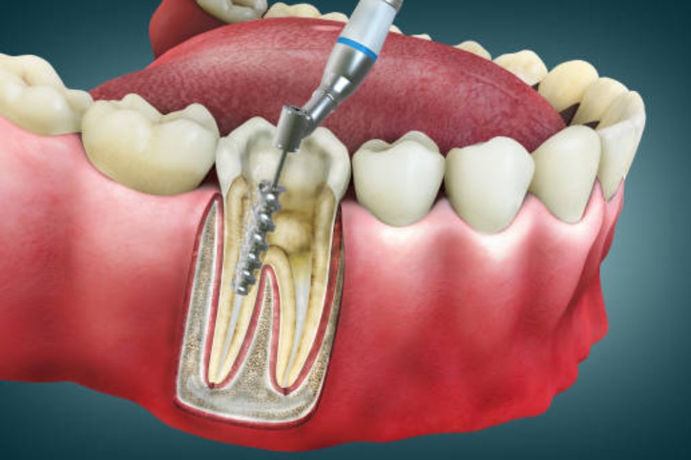 root-canal-treatment-types-which-one-do-you-need