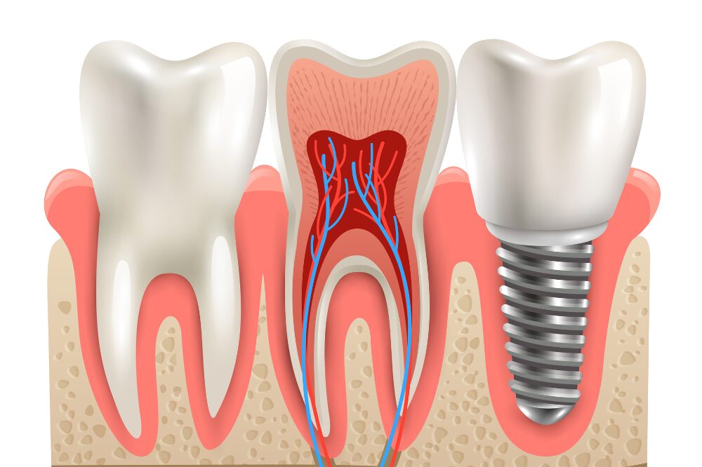 how do dentists determine if you’re a good candidate for implants