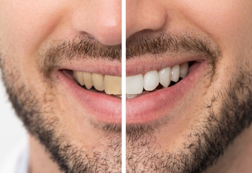 What's the Best Teeth Whitening For Smokers