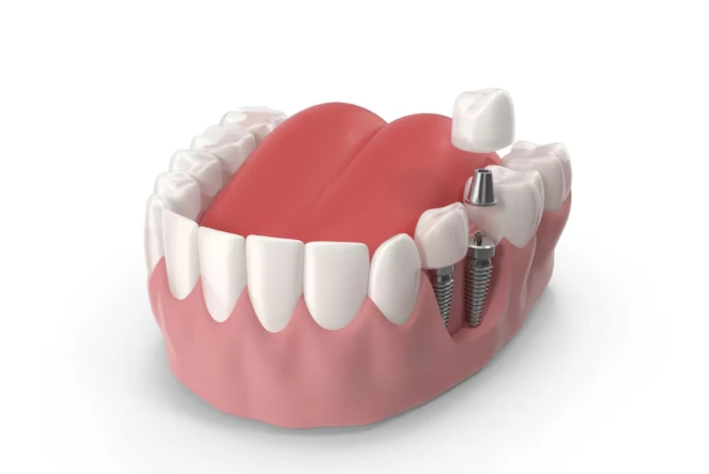 dental implant procedure for missing teeth