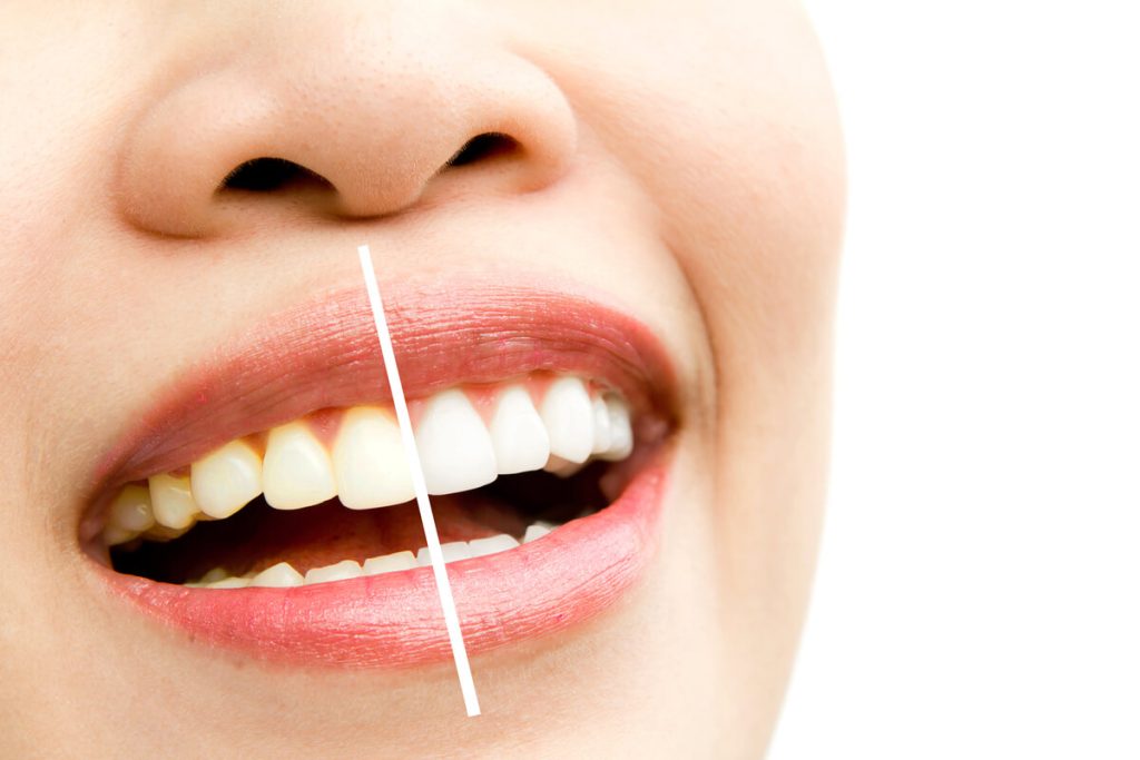 do teeth go back to normal after teeth whitening