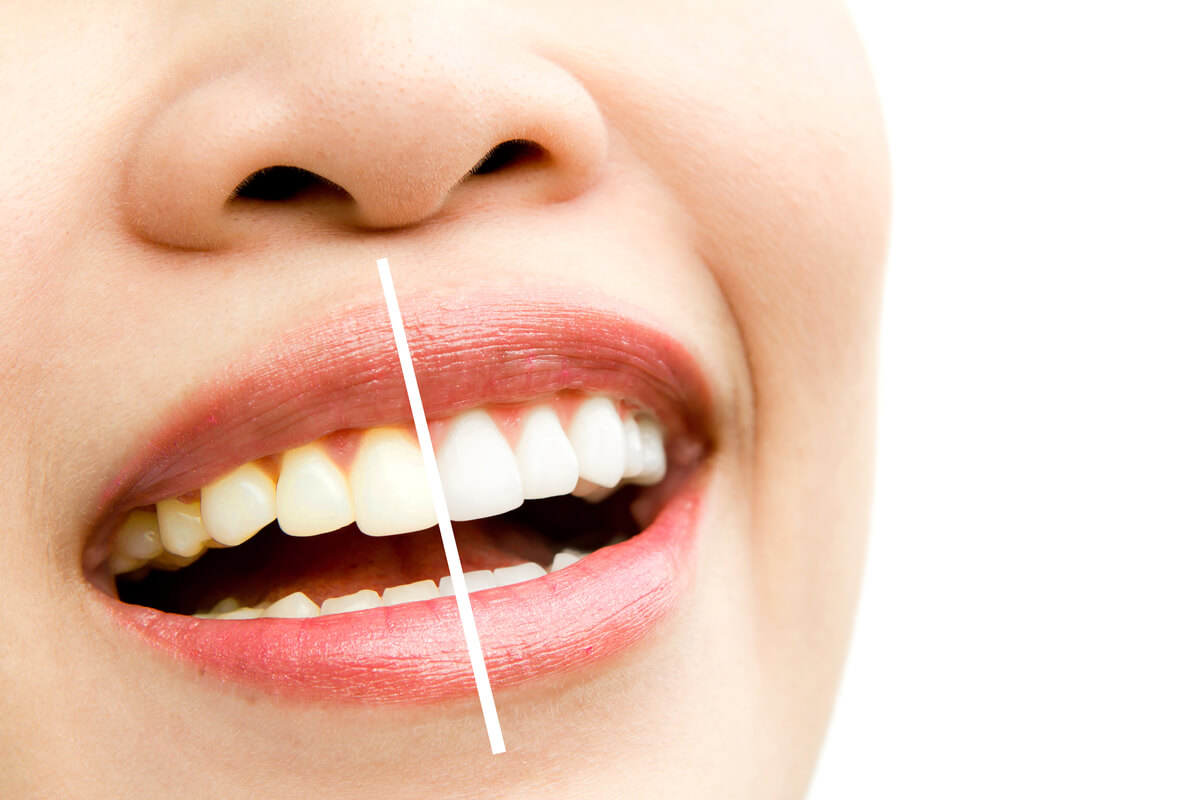 do teeth go back to normal after teeth whitening
