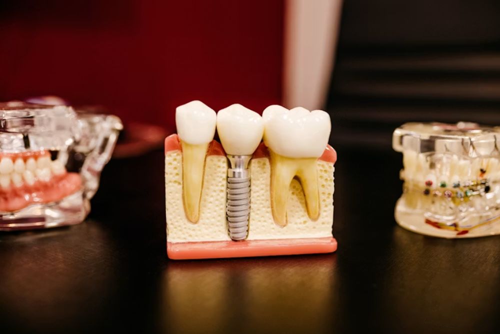 dental implant model illustrating tooth replacement compared with traditional dentures